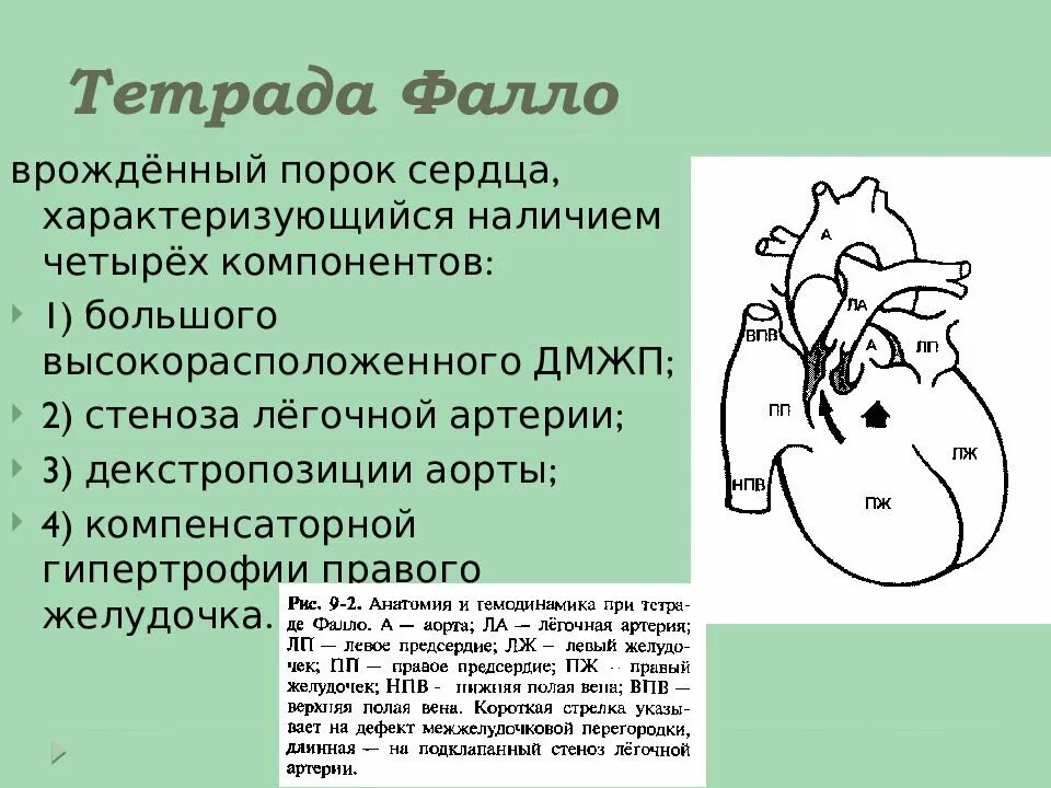 5 врожденных пороков сердца. Тетрада фалло дефект межжелудочковой перегородки. компоненты тетрады фалло. тетрада фалло порок сердца. тетрада фалло это врожденный порок.