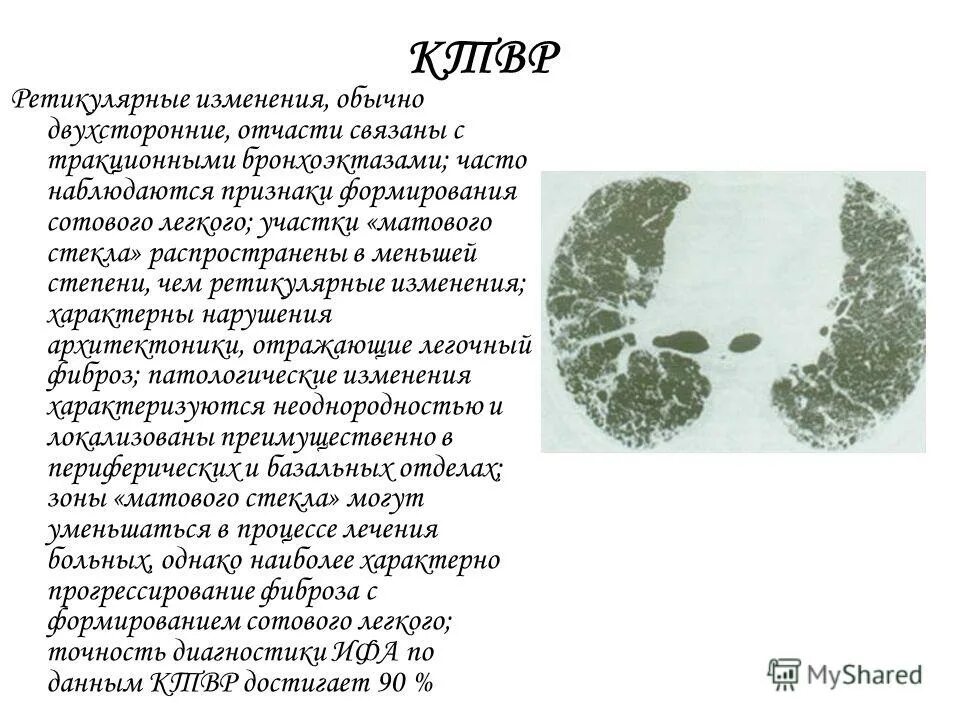 Интерстициальные болезни легких кт. Интерстициальный пневмофиброз на кт. Ретикулярные изменения в легких при кт. Ретикулярные изменения в легких при кт. Утолщение интерстиция кт легких.