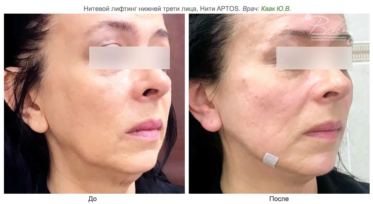 Лицо до и после мезонитей Нити Аптос фотографии до и после