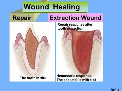 Wound healing