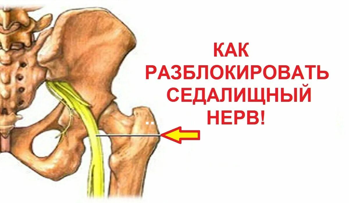 Можно ли греть при защемлении. Седалищный нерв. Защемление седалищного нерва. Воспаление и защемление седалищного нерва. Схема защемления седалищного нерва.