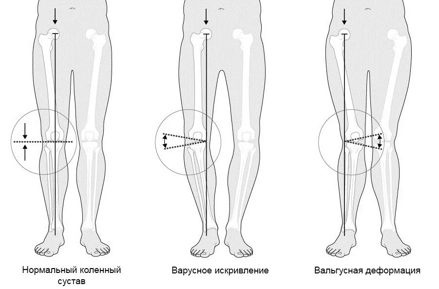 Вальгусная деформация коленных суставов у ребенка. Варусная деформация коленных суставов рентген. варусная деформация голени рентген. вальгусная деформация коленных суставов рентген степени. варусная деформация колена рентген.