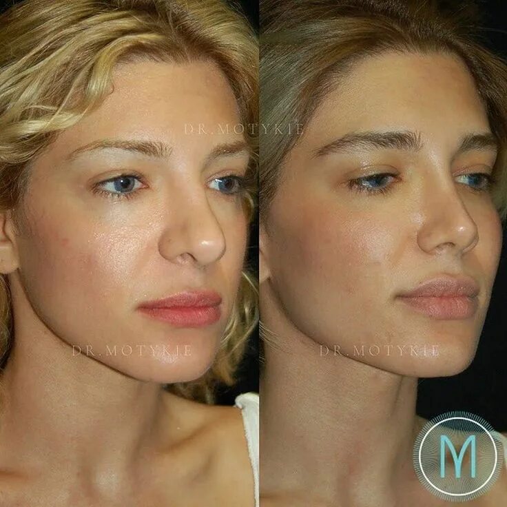 Instagram Rhinoplasty nose jobs, Nose job, Nose surgery rhinoplasty