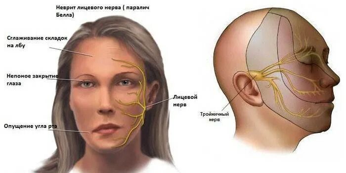 Воспаление тройничного лицевого нерва симптомы. Нерв тройничный лицевой воспалился. Лицевой нерв и тройничный нерв. Неврит лицевого нерва и тройничного нерва. Неврит лицевого нерва глаза