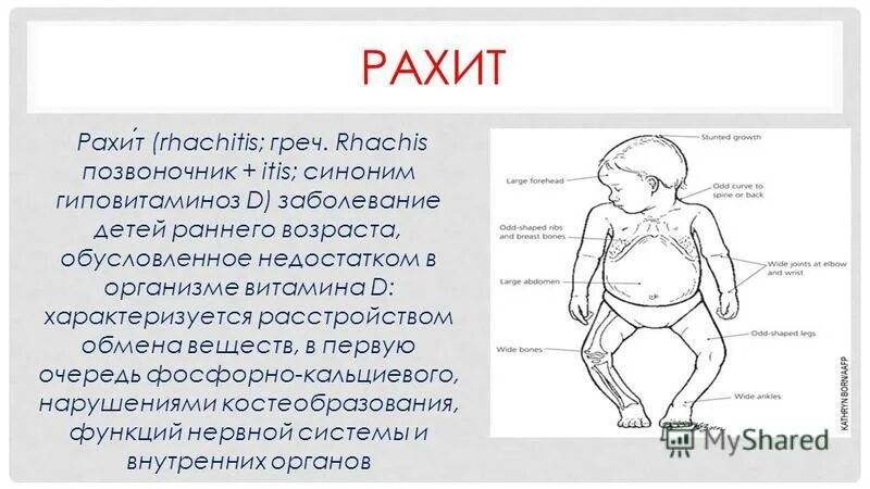 Рахит у детей. Рахит недостаток витамина д.