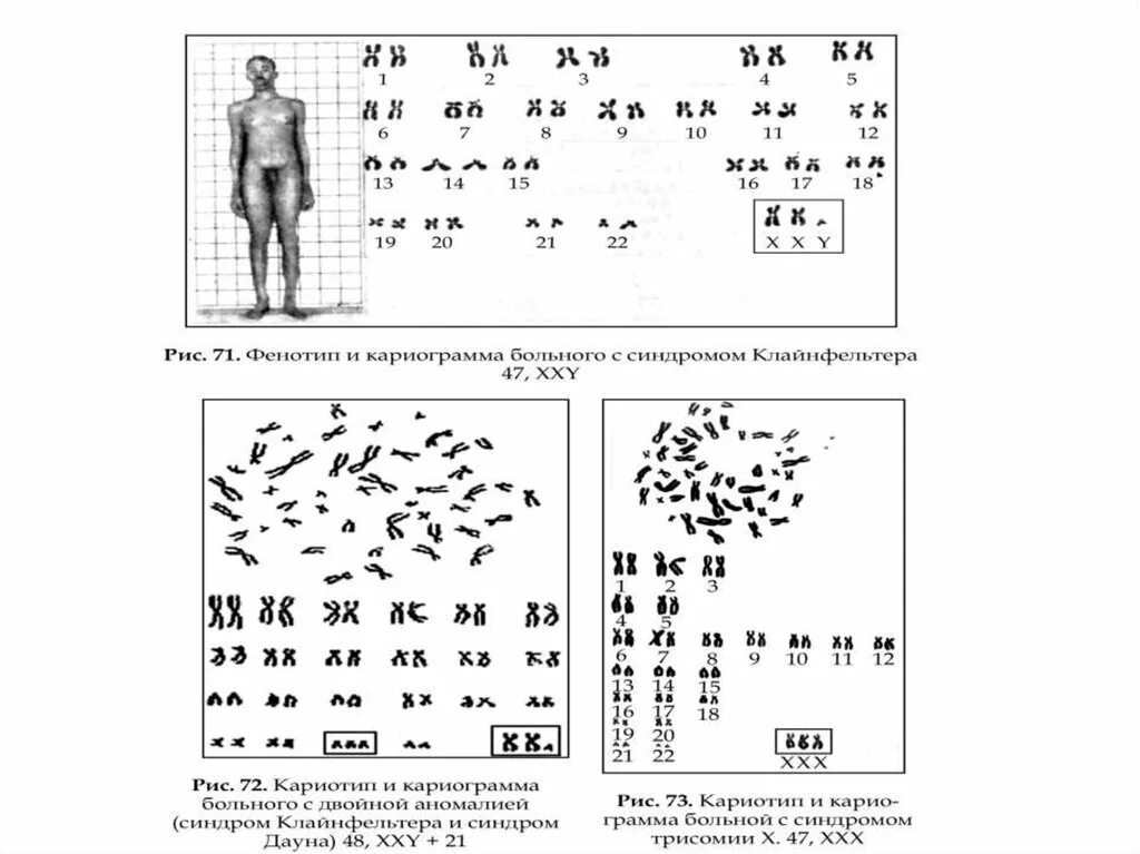 Синдром Клайнфельтера идиограмма. Синдром Клайнфельтера цитогенетический метод. Хромосомный набор больных с синдромом Клайнфельтера. Набор хромосом при синдроме Клайнфельтера.