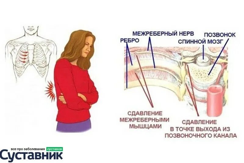 Межребеберная неврология. Межреберная невралоги. Меж ребренная невралгия. Меж робреная невралгаия. Межреберная невралгия лечение в домашних условиях слева