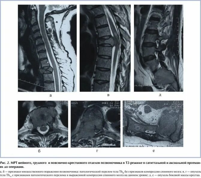 Мрт спинного отдела. Перелом грудного отдела позвоночника мрт. Мрт пояснично-крестцового отдела позвоночника. Мрт шейного, грудного, пояснично-крестцового отделов позвоночника. Перелом шейного отдела позвоночника мрт.