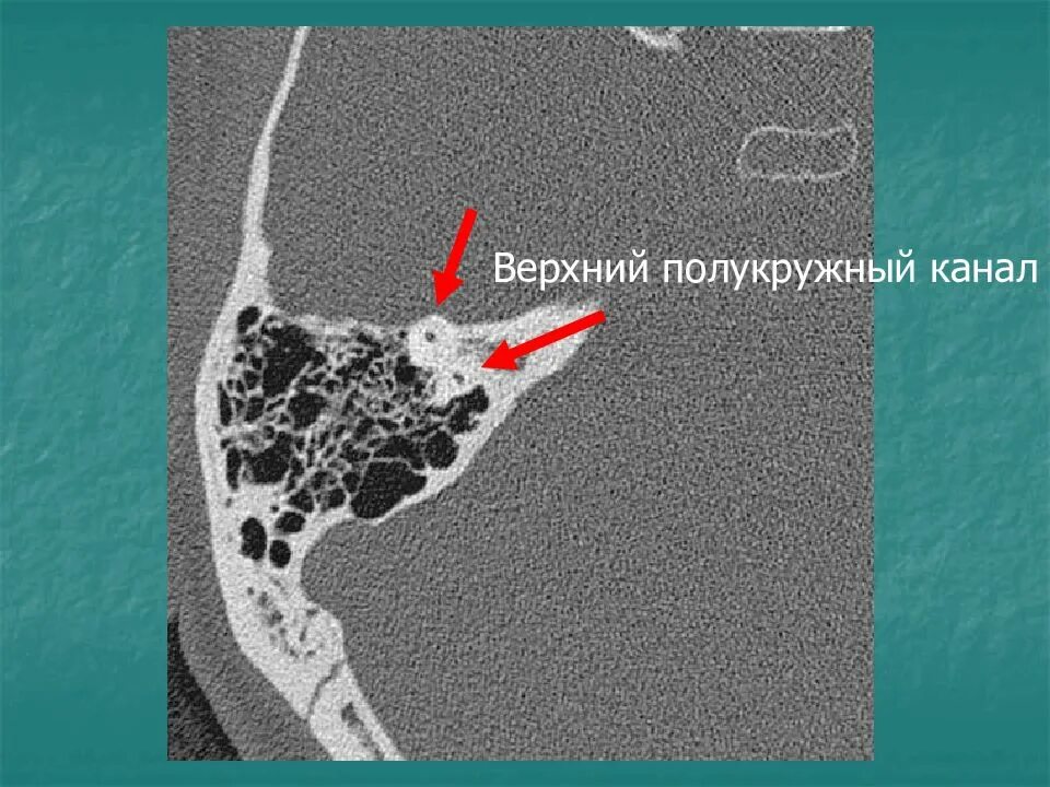 Сосцевидный отросток височной кости кт. Кт анатомия сосцевидного отростка. Рентгенография, кт височной кости. Кт сосцевидного отростка височной кости отит.