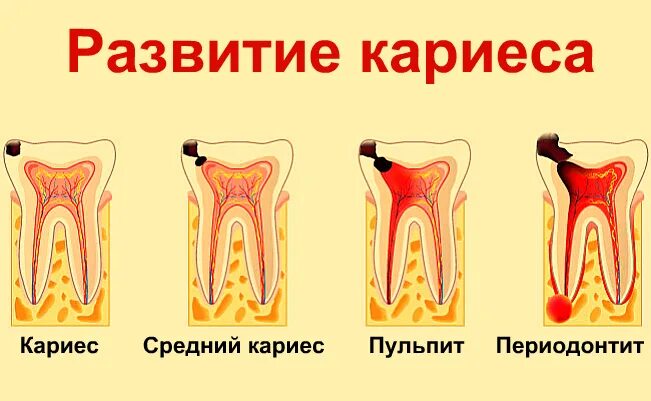 Сколько развивается кариес. Кариес пульпит периодонтит схема. этапы появления кариеса.