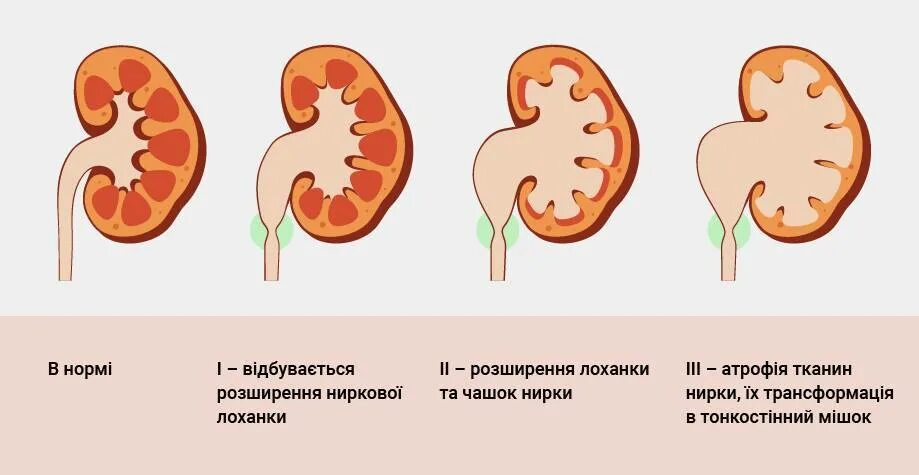 Почему увеличена почка