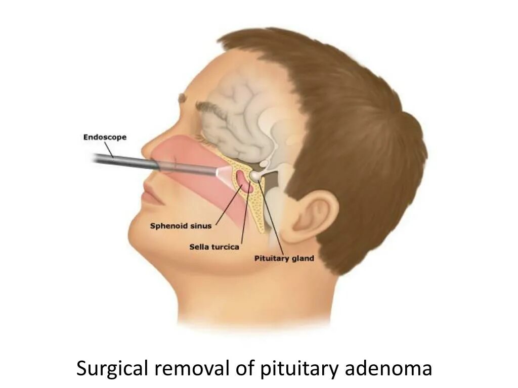 Гипофиз седло. Турецкое седло в головном мозге. Гипофиз в турецком седле. Строение головного мозга турецкое седло. Турецкое седлогодовного мозга.