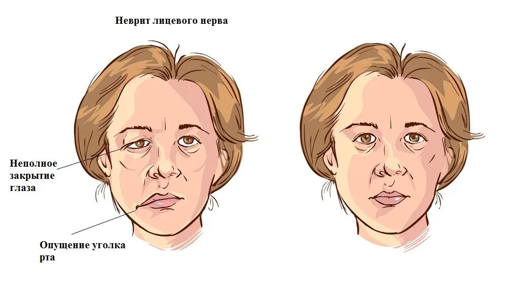 Лицевой нерв после операции. Невропатия (неврит) лицевого нерва..