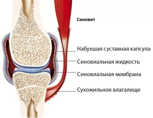 Выпот в полости коленного сустава. Симптомы синовита коленного сустава. Синовит синовиальная оболочка. Воспаление синовиальной оболочки сустава. Синовит надколенной сумки.