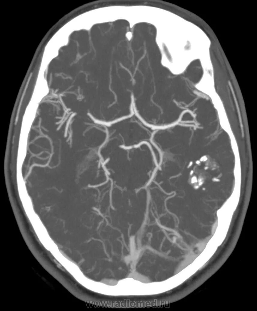 Ангиома мозга лечение. Кавернозная ангиома головного мозга кт. Кавернозная мальформация мрт. Кавернозная ангиома мрт. Кавернома на кт.