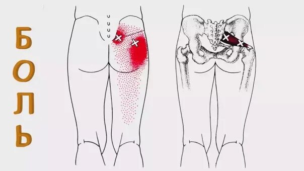 Сильно болят ягодицы. Миофасциальный синдром триггеры. Синдром грушевидной мышцы ягодицы. Триггерные точки грушевидной мышцы массаж. Миофасциальный синдром точки.