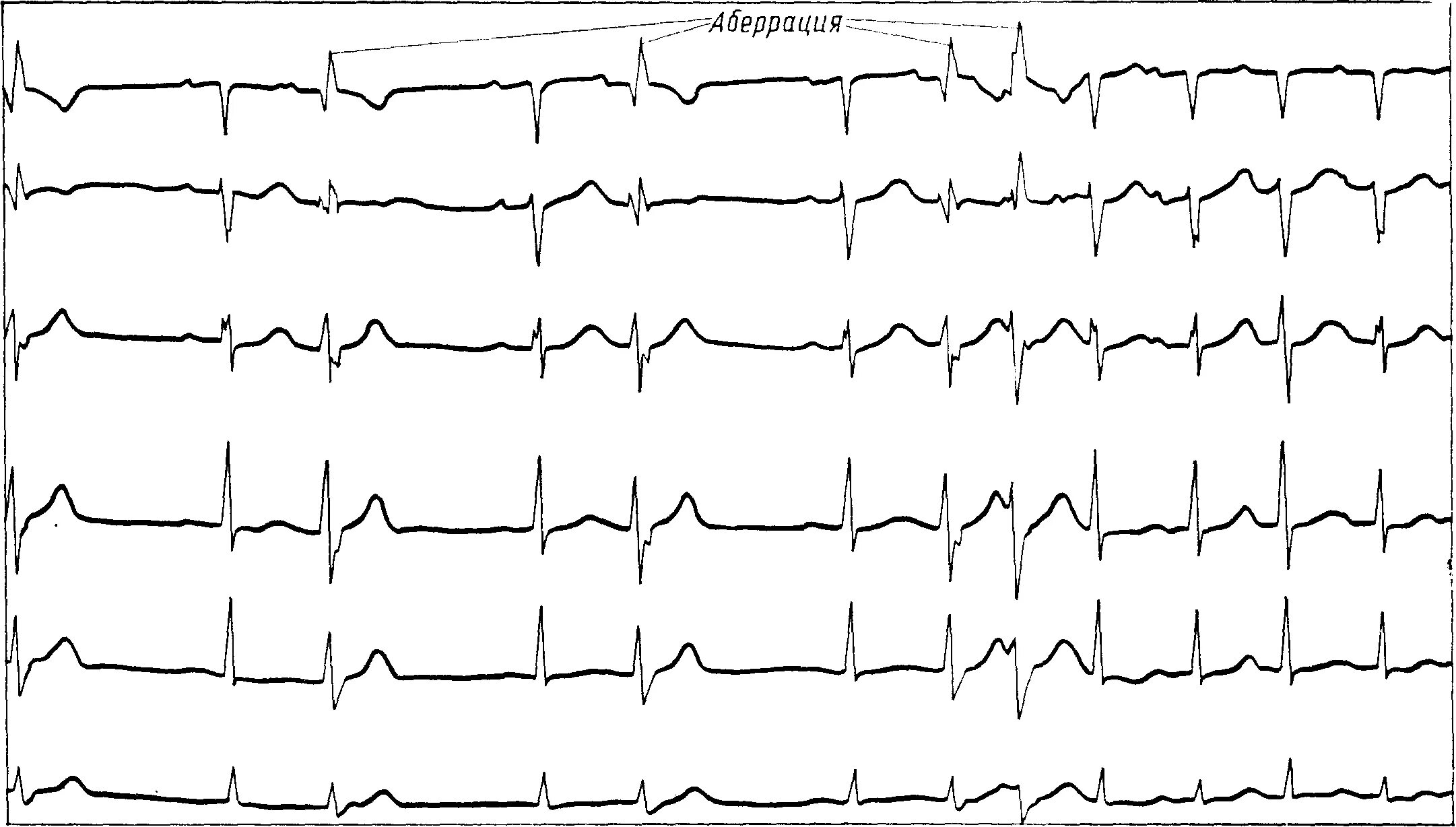 Аберрантные экстрасистолы на ЭКГ. Аберрантная предсердная экстрасистолия на ЭКГ. Аберрантная экстрасистолия на ЭКГ. Экстрасистола с аберрантным проведением на ЭКГ. Аберрантные экстрасистолы