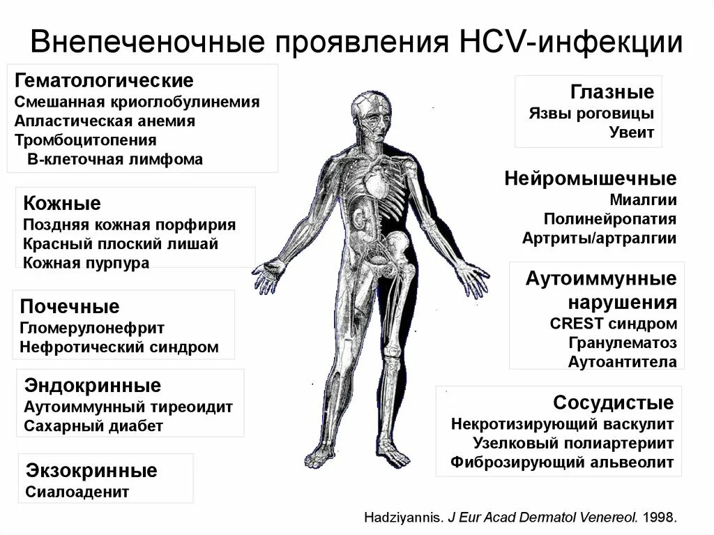 Внепеченочные проявления HCV-инфекции. Внепеченочные проявления при вирусных гепатитах. Внепеченочные проявления гепатита с. Внепеченочное проявление хронического гепатита с:.