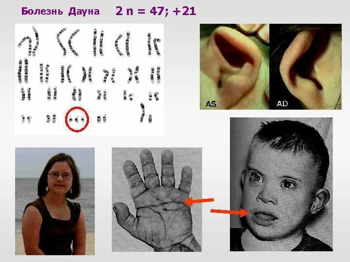 Болезнь дауна какой. Синдром Дауна внешние черты. Болезнь Дауна болезнь Дауна.
