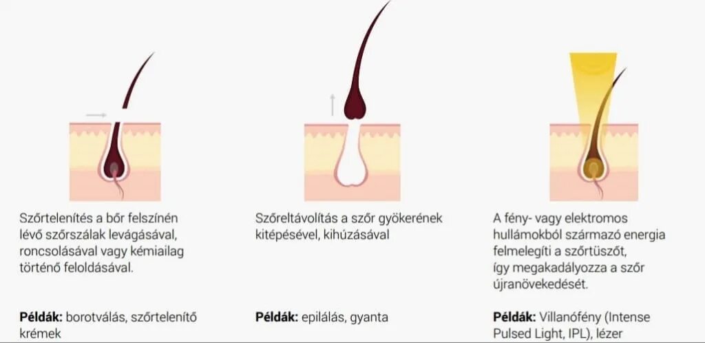 Волос отращивать шугаринг. Этапы роста волос. Рост волос после шугаринга. Волосяная луковица.