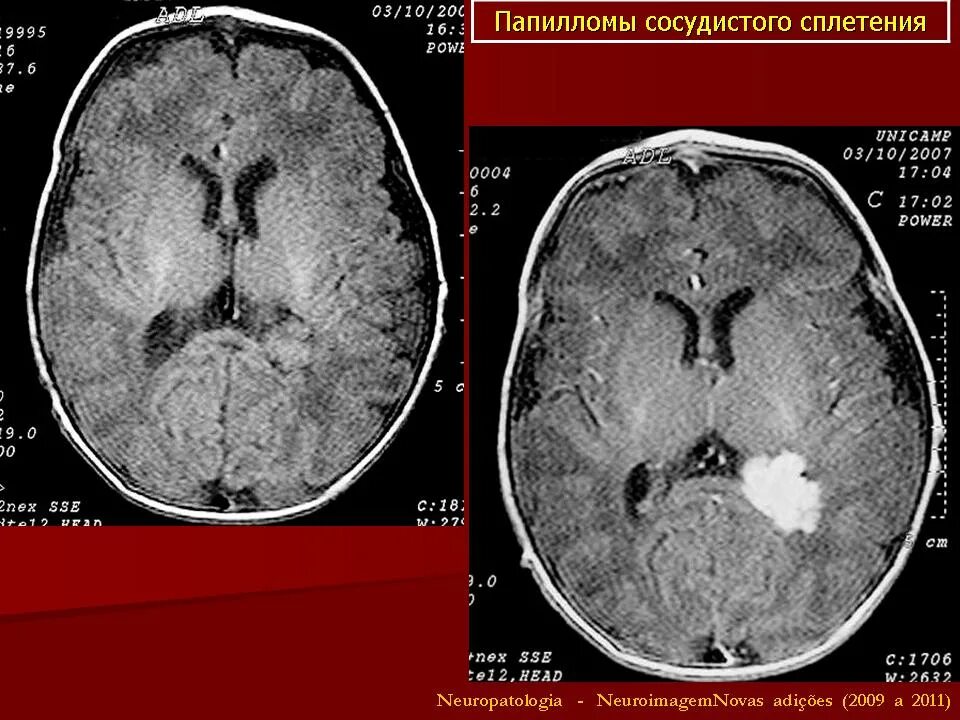 У плода киста мозга сплетения