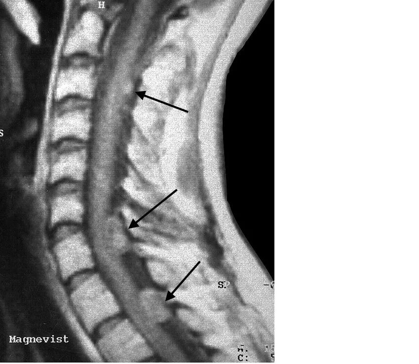 Экстрамедуллярные опухоли спинного мозга мрт. Невринома спинного мозга мрт. Опухоль спинного мозга шейного отдела позвоночника мрт. Нейрофиброматоз мрт позвоночника. Опухоль в поясничном отделе