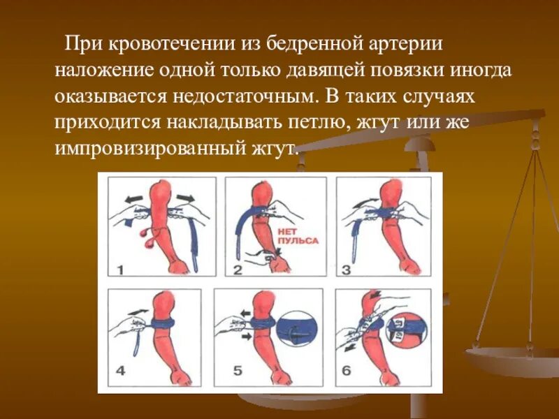 Артериальное кровотечение в области бедра