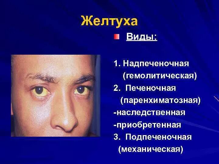 Желтуха симптомы у детей. Надпечёночная желтуха. Паренхиматозная желтуха. Виды желтух. Механическая желтуха надпеченочная.