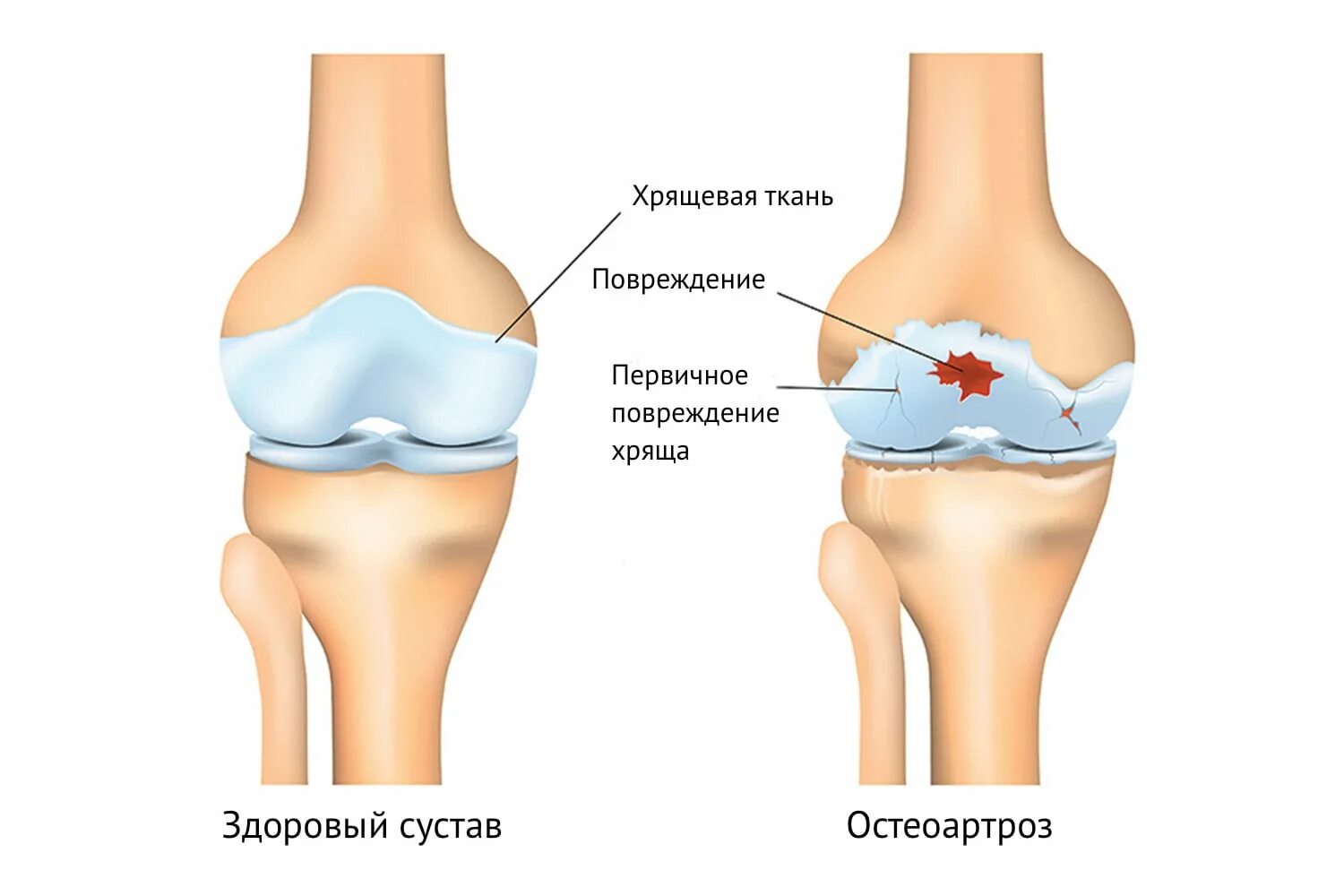 Коленный сустав по стадиям. Первичный деформирующий остеоартроз. Деформирующий артроз коленного сустава схема. Деформирующий остеоартроз поражение суставов. Деформирующий остеоартрит коленного сустава.