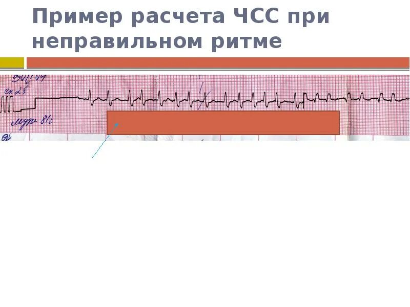 Чсс по экг 25. Чсс на экг неправильный ритм. чсс при неправильном ритме на экг. подсчет чсс при неправильном ритме по экг. как рассчитать чсс при неправильном ритме.