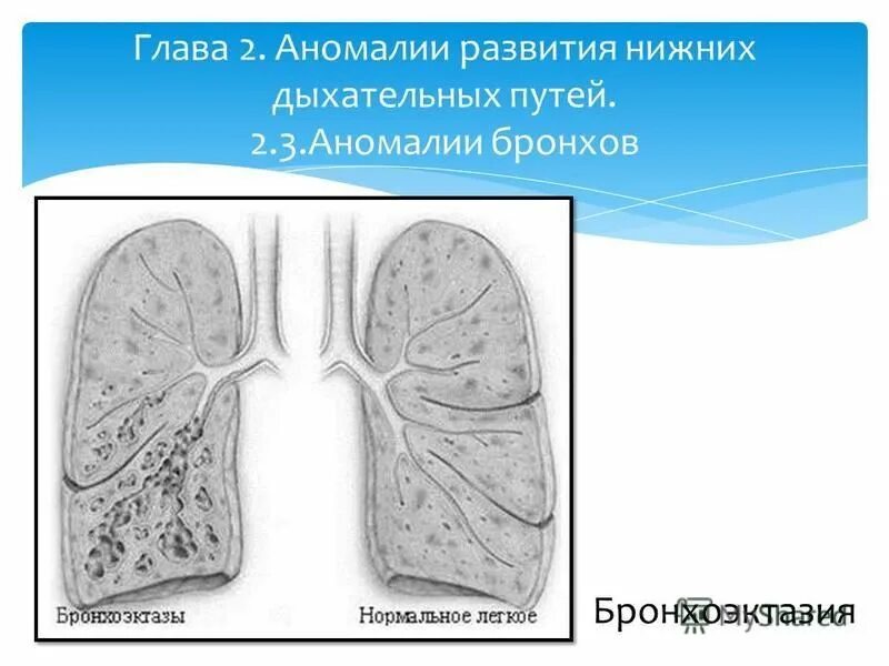Аномалии органов дыхания. Аномалии органов дыхания