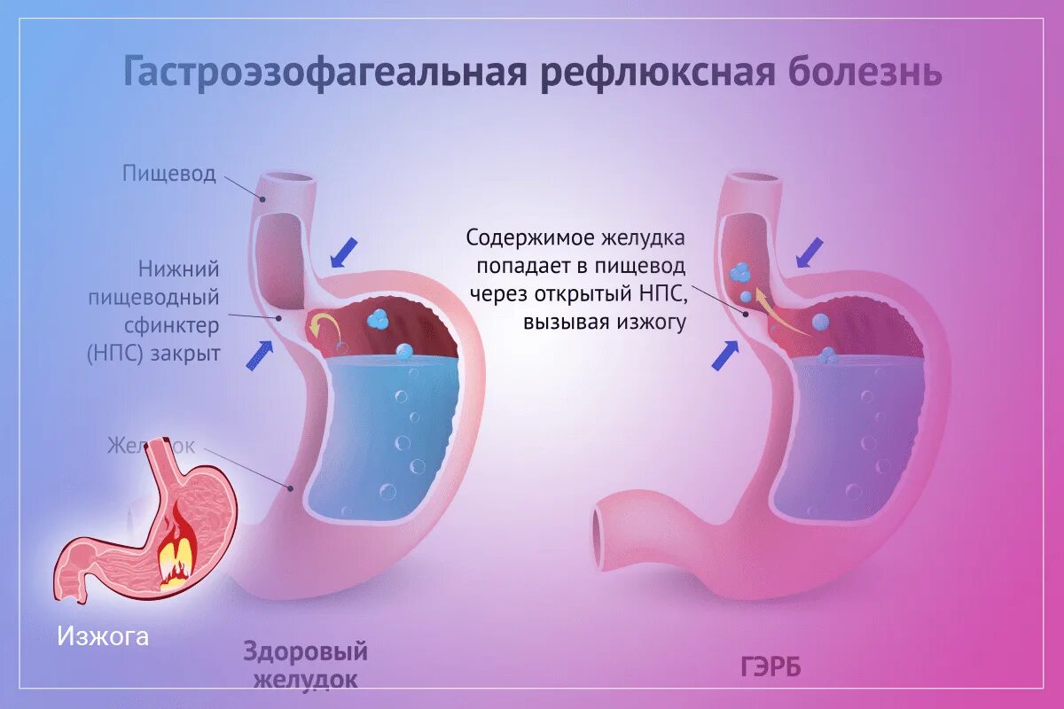 Гастро-эзофагальный рефлюкс. Рефлюксная болезнь сфинктер. Клапан между желудком и пищеводом. Гастроэзофагеальный (желудочно-пищеводный) рефлюкс.
