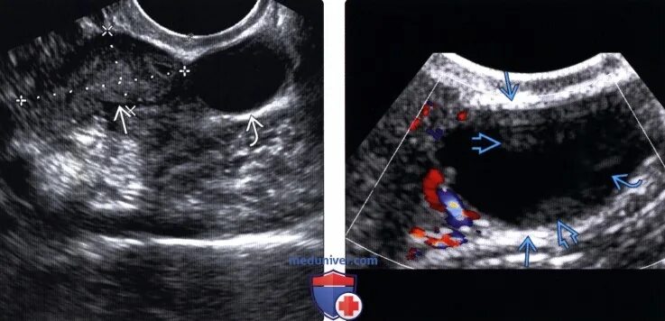 Надо ли удалять параовариальную кисту. Параовариальная киста на УЗИ. Параовариальная киста и гидросальпинкс. Параовариальная киста яичника. Параовариальная киста на УЗИ яичника.