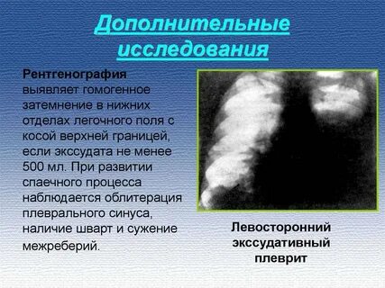 Течение плеврита