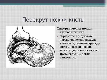 Анатомическая и хирургическая ножка опухоли яичника