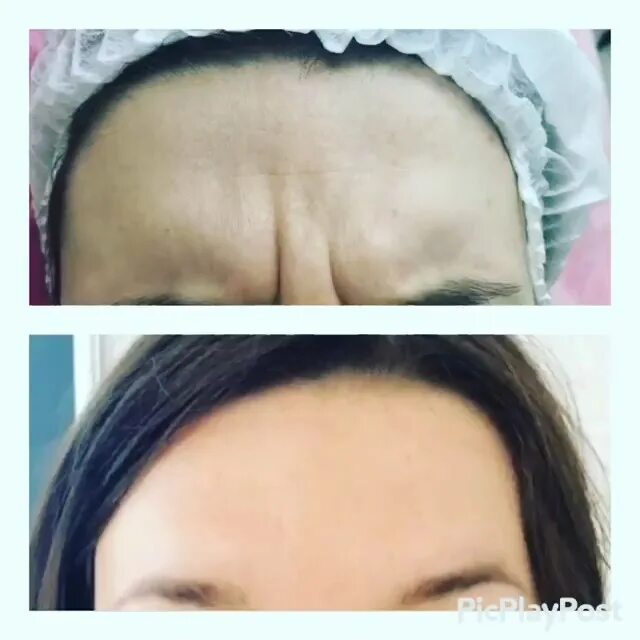 После ботокса нельзя лежать