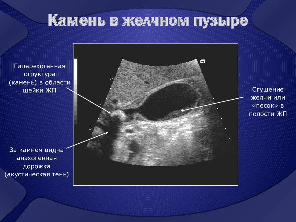 Образование без акустической тени. Конкременты желчного пузыря УЗИ. Камень желчного пузыря на ультразвуке УЗИ. Конкреиеетв в ролости желчнооо пузыеа. Камни в желчном пузыре УЗИ.