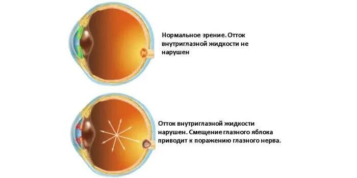 Зрение 3 это много. Зрение -3. Зрение -3.25. Изменения на глазном дне. Какая потеря зрения при -10.