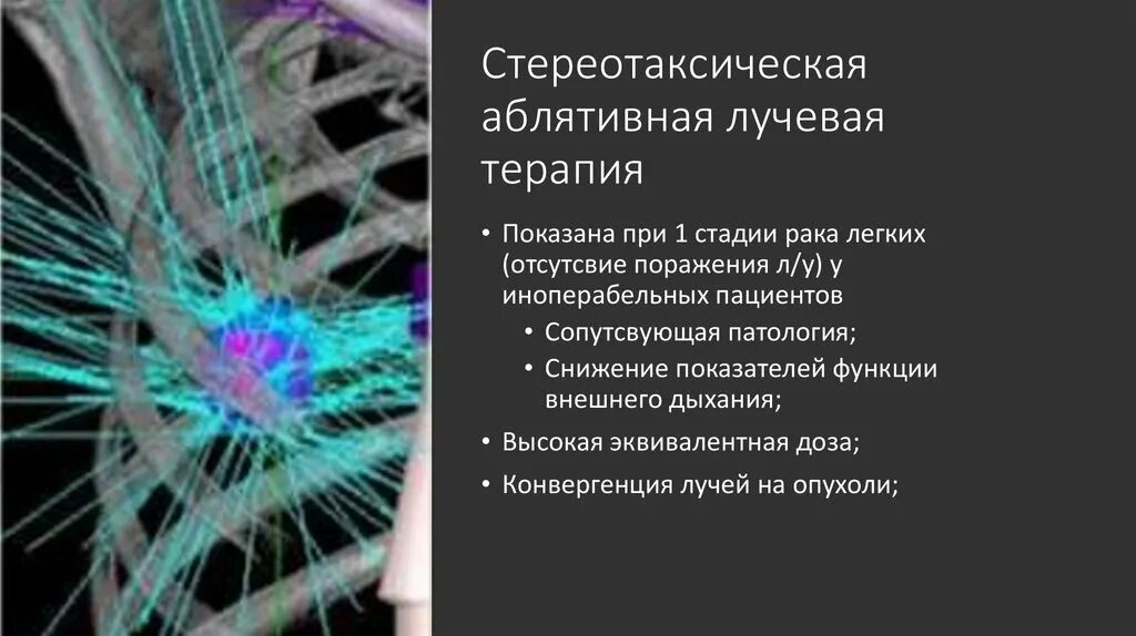 Последствия лучевой терапии отзывы пациентов. Лучевая терапия при онкологии легкого. Стереотаксическая лучевая терапия. Лучевая терапия при онкологии легких последствия. Последствия стереотаксической лучевой терапии.