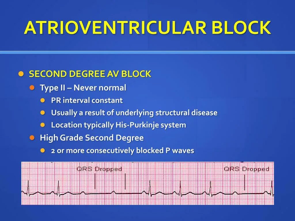 Atrioventricular Block. Av Block. Pacemaker av Block. ECG av Block 3.