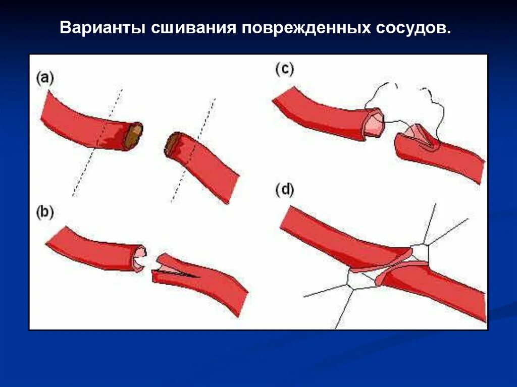 Повреждение кровеносных сосудов.