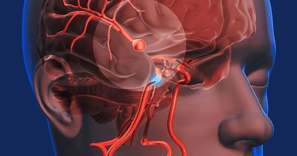 Аневризма сосудов головного мозга. Аневризмы сосудов мозга. Аневризм сосудов головного мозга. Врожденные аневризмы головного мозга. Аневризма мозга простыми словами