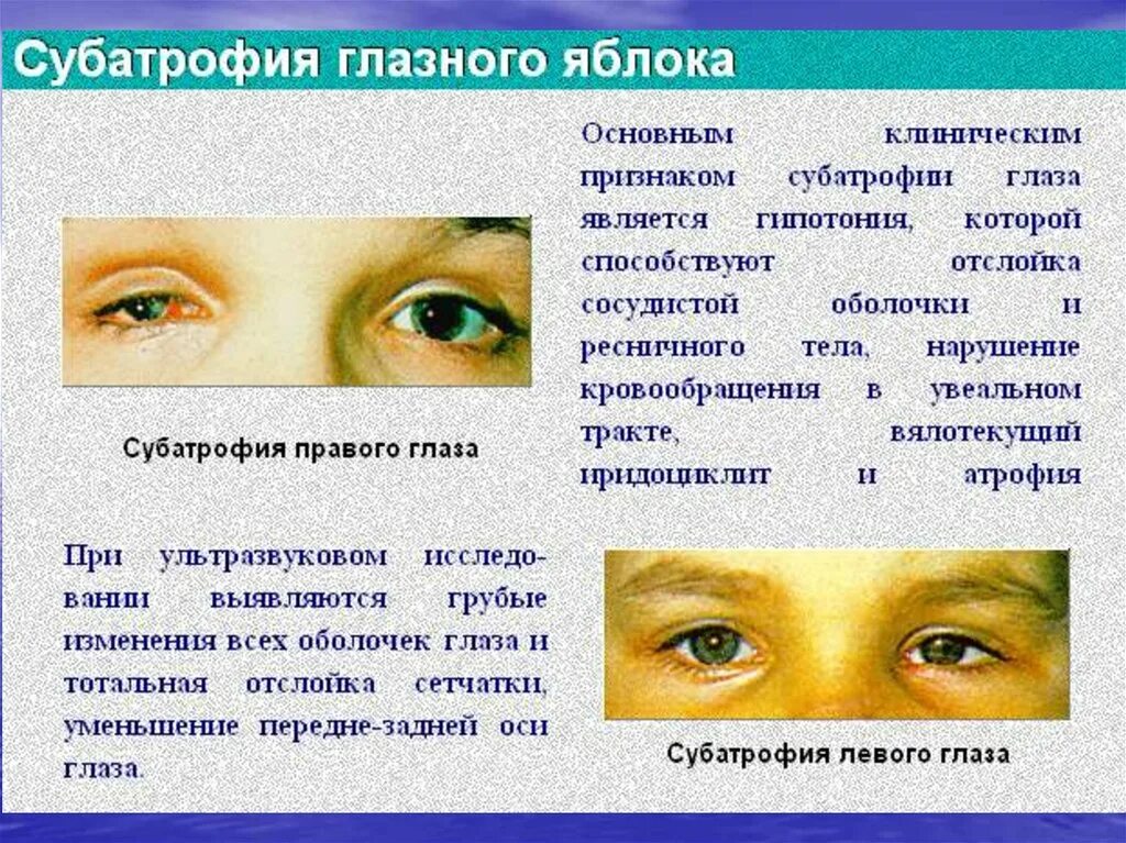 Субатрофия глазного яблока. Повреждения органа зрения. Гипотония глазного яблока. Почему уменьшился глаз