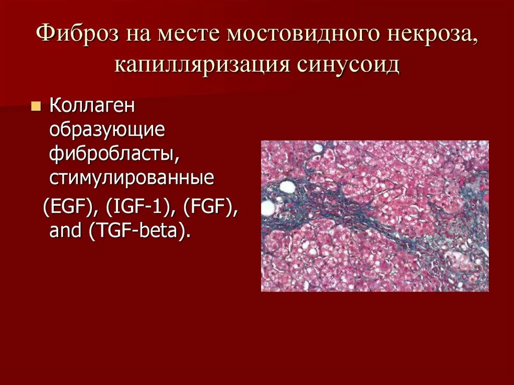 Мостовидные некрозы печени гистология. Ступенчатый некроз печени. Ступенчатые и мостовидные некрозы.