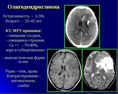 Мрт симптомы