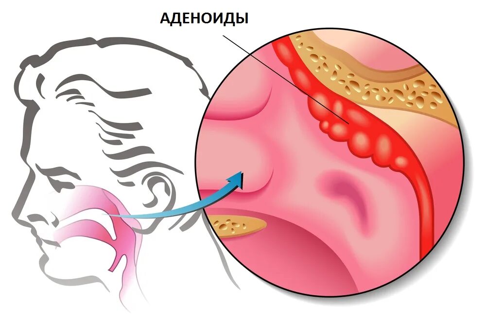 Как лечить аденоиды. Анатомия носоглотки аденоиды.