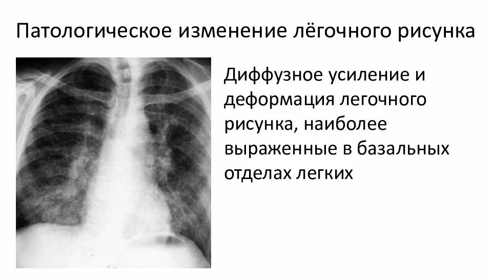 Легочный рисунок диффузно усилен. Легочный рисунок деформирован. Диффузное усиление легочного рисунка что это такое. Диффузные изменения легочного рисунка. Изменения базальных отделов легких