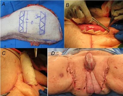 Skin Grafting Before And After 