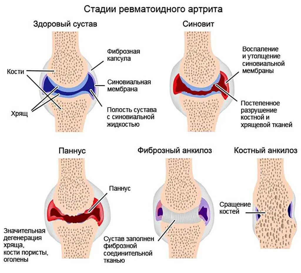 Стадии синовита при ревматоидном артрите. Ревматоидный артрит суставы схема. ,Синовит синовита коленного сустава. Неэрозивный ревматоидный артрит. С какой частотой обновляются кости