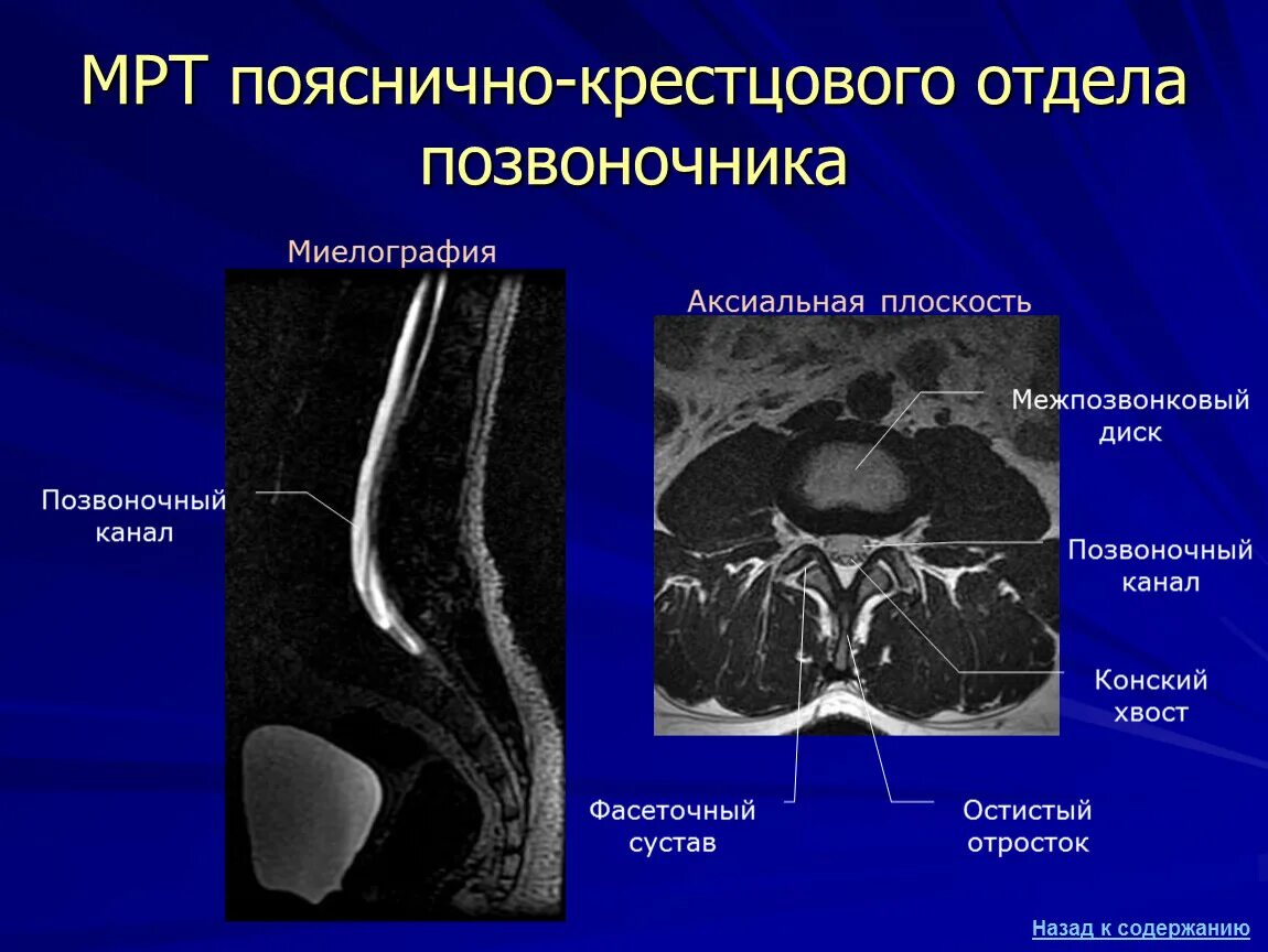 Мрт спинного отдела. Кт пояснично-крестцового отдела позвоночника норма. Кт позвоночно крестцового отдела. Мрт пояснично-крестцового отдела позвоночника. Мрт поясничнокресцового отдела позвоночника.